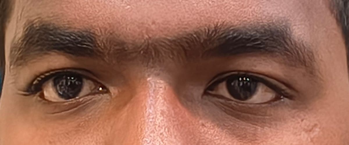 After vision therapy: both eyes look straight ahead together.